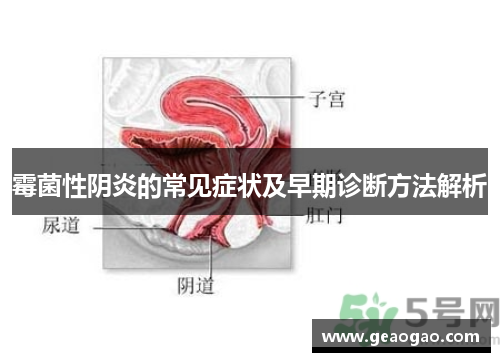 霉菌性阴炎的常见症状及早期诊断方法解析